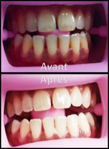Blanchiment dentaire 3